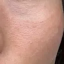 美肌レーザー LEX BEAUTY CLINIC DAY 5 サムネイル用