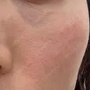 美肌レーザー LEX BEAUTY CLINIC DAY 6 サムネイル用