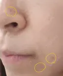 ほくろ・いぼ切除（肌） CLINIC W DAY 27 サムネイル用