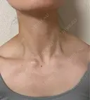 ボトックス（エラ・小顔） DMTC CLINIC 日本橋院 AFTER サムネイル用