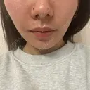 ボトックス（ガミースマイル） / ヒアルロン酸注入（鼻翼基部） ziz CLINIC AFTER サムネイル用