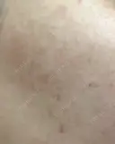 ヒアルロン酸注入（涙袋） / ヒアルロン酸注入（唇） / ボトックス（肩） / ボトックス（首） / シミ取りレーザー ルヴィクリニック イオンドーム前院 DAY 18 サムネイル用