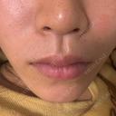 エレクトロポレーション BITO BEAUTY CLINIC DAY 0 サムネイル用