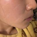 エレクトロポレーション BITO BEAUTY CLINIC DAY 0 サムネイル用