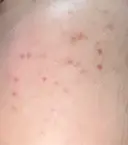 その他（肌） / ポテンツァ ルラ美容クリニック 郡山院 DAY 4 サムネイル用