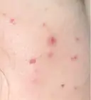 その他（肌） / ポテンツァ ルラ美容クリニック 郡山院 DAY 4 サムネイル用