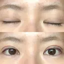 二重埋没 / 上まぶたの脂肪取り アリエル美容クリニック 郡山院 DAY 49 サムネイル用