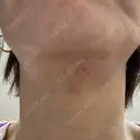 ヒアルロン酸溶解 / インモード Moon Beauty Clinic DAY 2 サムネイル用