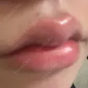 ヒアルロン酸注入（唇） / ボトックス（口角） ルラ美容クリニック 大阪本院 AFTER サムネイル用