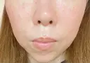 ピコレーザートーニング（美白・肝斑） 白金ビークリニック 本院 AFTER サムネイル用