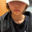 糸リフト / ボトックス（あご） / 肌ヒアルロン酸注入（たるみ・シワ改善） / ボトックス（ガミースマイル） ルラ美容クリニック 池袋院 AFTER サムネイル用