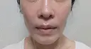 糸リフト / バッカルファット除去 / 脂肪吸引（顔） / ジョールファット除去 / ボトックス（エラ・小顔） アリエル美容クリニック 大宮院 DAY 110 サムネイル用