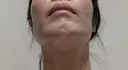 糸リフト / バッカルファット除去 / 脂肪吸引（顔） / ジョールファット除去 / ボトックス（エラ・小顔） アリエル美容クリニック 大宮院 DAY 110 サムネイル用