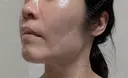 糸リフト / バッカルファット除去 / 脂肪吸引（顔） / ジョールファット除去 / ボトックス（エラ・小顔） アリエル美容クリニック 大宮院 DAY 110 サムネイル用