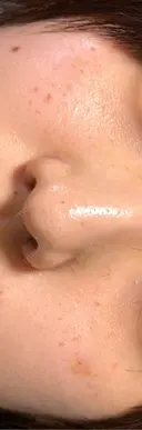 ルメッカ ハナビューティークリニック AFTER サムネイル用