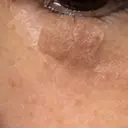 ほくろ・いぼ切除（肌） ルラ美容クリニック 横浜院 DAY 4 サムネイル用