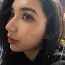 ヒアルロン酸注入（鼻） / ヒアルロン酸注入（鼻翼基部） HAAB×DREAM BEAUTY CLINIC 大阪梅田院 DAY 0 サムネイル用