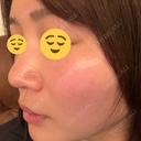 ルメッカ BITO BEAUTY CLINIC AFTER サムネイル用