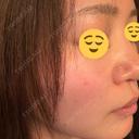 ルメッカ BITO BEAUTY CLINIC DAY 14 サムネイル用