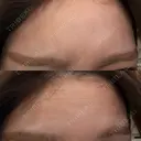 ボトックス（あご） / ボトックス（エラ・小顔） / ボトックス（口角） / ボトックス（眉間） / ボトックス（額） / ボトックス（首） 大美会クリニック 神戸院 AFTER サムネイル用