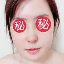 鼻中隔延長（切開） / 骨切り（あご） / 骨削り（エラ） / 軟骨移植 / 眉間プロテーゼ id（アイディ）美容外科 DAY 7 サムネイル用