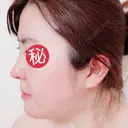 鼻中隔延長（切開） / 骨切り（あご） / 骨削り（エラ） / 軟骨移植 / 眉間プロテーゼ id（アイディ）美容外科 DAY 7 サムネイル用