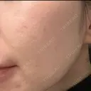 光治療（フォトフェイシャルなど） / ミラノリピール トラスト美容クリニック 銀座院 AFTER サムネイル用