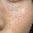 美肌レーザー LEX BEAUTY CLINIC DAY 8 サムネイル用