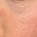 美肌レーザー LEX BEAUTY CLINIC DAY 9 サムネイル用