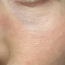 その他（目元） 品川スキンクリニック広島院 DAY 1 サムネイル用