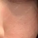 美肌レーザー LEX BEAUTY CLINIC DAY 11 サムネイル用