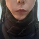 糸リフト 形成外科と美容外科のクリニック池袋 AFTER サムネイル用