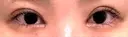 二重埋没 / 目頭切開 湘南美容クリニック 千葉センシティ院 AFTER サムネイル用
