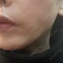 糸リフト 形成外科と美容外科のクリニック池袋 DAY 0 サムネイル用