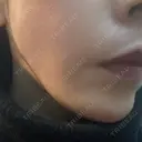 糸リフト 形成外科と美容外科のクリニック池袋 DAY 0 サムネイル用