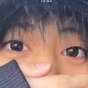 ヒアルロン酸注入（涙袋） サラ美容外科 AFTER サムネイル用