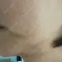 ヒアルロン酸溶解 / インモード Moon Beauty Clinic DAY 5 サムネイル用