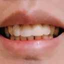 セラミック 東京美容外科 赤坂院 DAY 16 サムネイル用