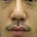 小鼻縮小（切開） 渋谷の森クリニック DAY 7 サムネイル用