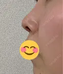 鼻尖形成（切開） / 鼻中隔延長（切開） / 軟骨移植 / 眉間プロテーゼ eクリニック 福岡院 DAY 41 サムネイル用