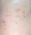 その他（肌） / ポテンツァ ルラ美容クリニック 郡山院 DAY 7 サムネイル用