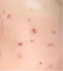 その他（肌） / ポテンツァ ルラ美容クリニック 郡山院 DAY 7 サムネイル用