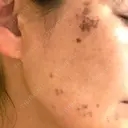 シミ取りレーザー S-Laboクリニック 渋谷院 DAY 1 サムネイル用