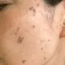 シミ取りレーザー S-Laboクリニック 渋谷院 DAY 1 サムネイル用