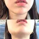 ハイフ（顔） / LDM・インテンスウルトラ 美容皮膚科ティファクリニック 新宿東口 AFTER サムネイル用