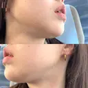 ハイフ（顔） / LDM・インテンスウルトラ 美容皮膚科ティファクリニック 新宿東口 DAY 3 サムネイル用