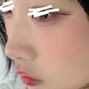 ヒアルロン酸注入（涙袋） / ヒアルロン酸注入（鼻） / ヒアルロン酸注入（あご） / ボトックス（エラ・小顔） / ヒアルロン酸注入（唇） / ヒアルロン酸注入（頬） HAAB×DREAM BEAUTY CLINIC 大阪梅田院 AFTER サムネイル用