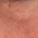 ほくろ・いぼ切除（肌） ルラ美容クリニック 横浜院 AFTER サムネイル用