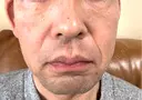 RF（高周波）たるみ治療 plume clinic AFTER サムネイル用