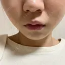 イオン導入 / ルメッカ やさしい美容皮膚科・皮フ科　秋葉原院 AFTER サムネイル用
